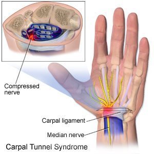 carpal tunnel surgery aftercare instructions uk